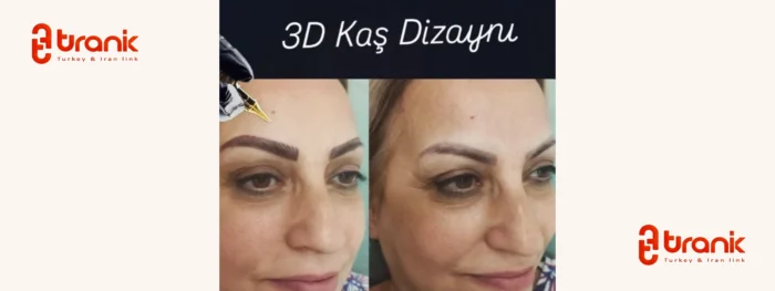 میکروبلیدینگ بیلیک‌دوزو
