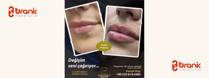 فیلر در آنکارا