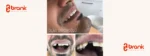 ایمپلنت دندان در آنتالیا