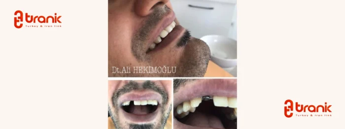ایمپلنت دندان در آنتالیا